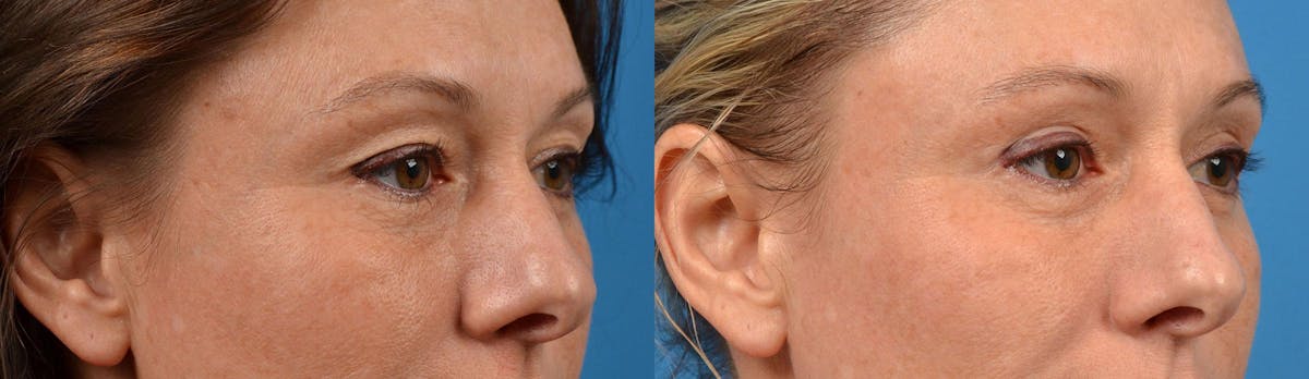 Eyelid Surgery Before & After Gallery - Patient 122444629 - Image 2