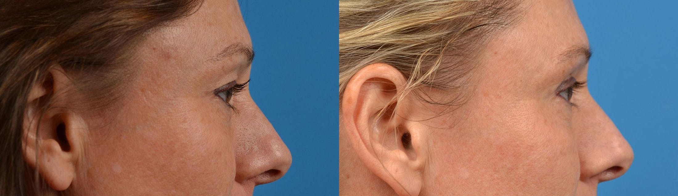 Eyelid Surgery Before & After Gallery - Patient 122444629 - Image 3