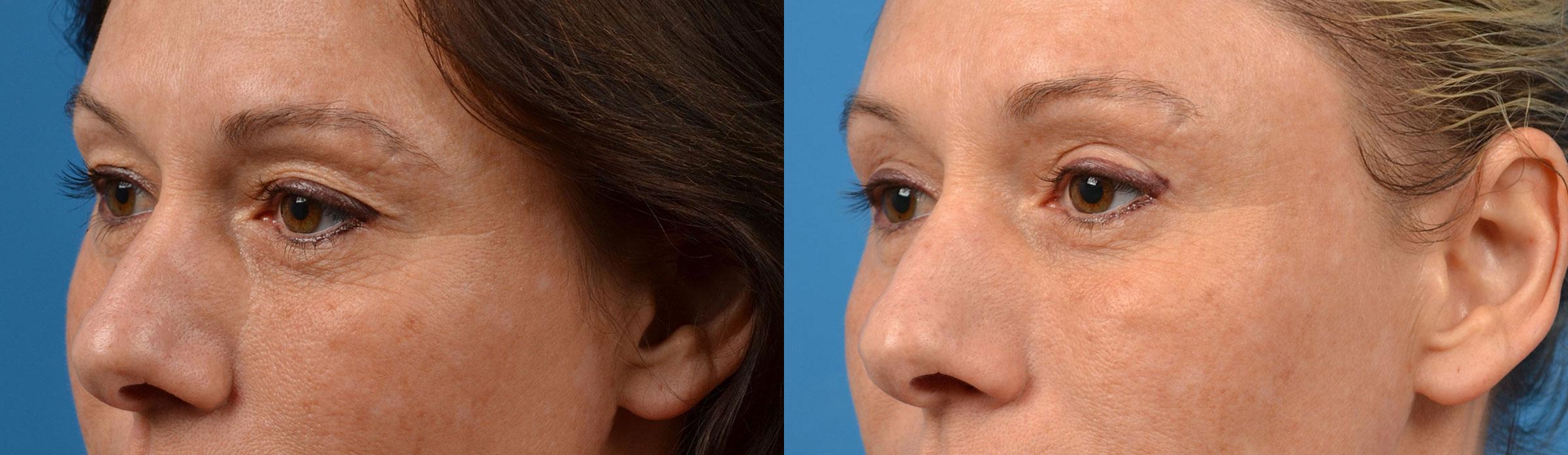 Eyelid Surgery Before & After Gallery - Patient 207373 - Image 4