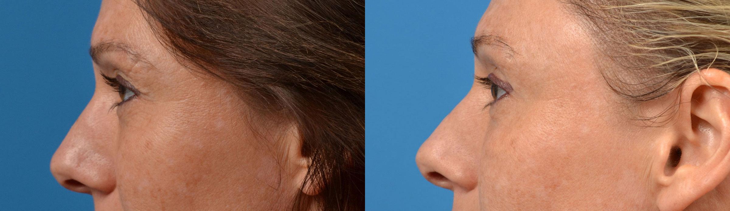 Eyelid Surgery Before & After Gallery - Patient 207373 - Image 5