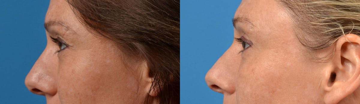 Eyelid Surgery Before & After Gallery - Patient 122444629 - Image 5