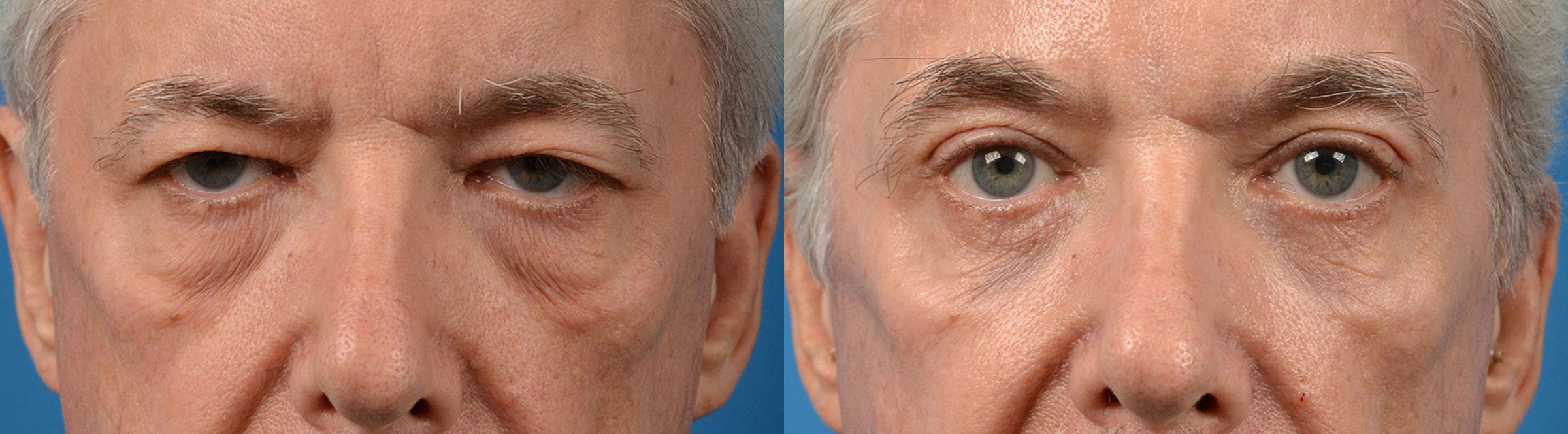 Eyelid Surgery Before & After Gallery - Patient 272484 - Image 1