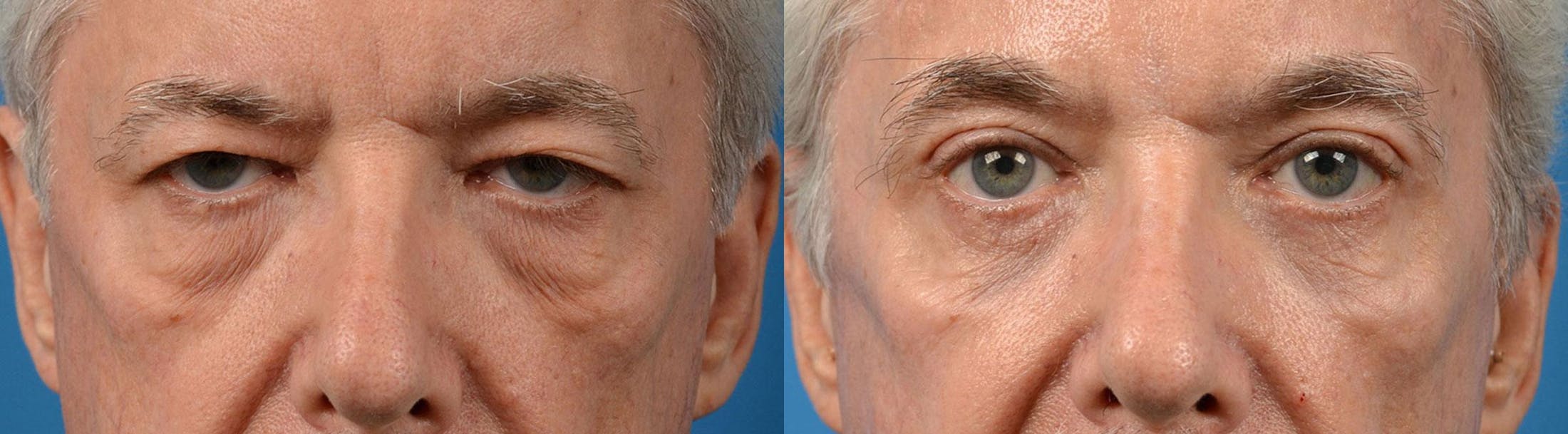Eyelid Surgery Gallery - Patient 122444638 - Image 1
