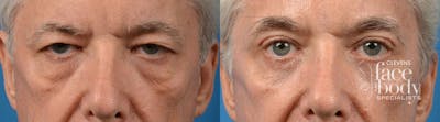 Eyelid Surgery Before & After Gallery - Patient 272484 - Image 1