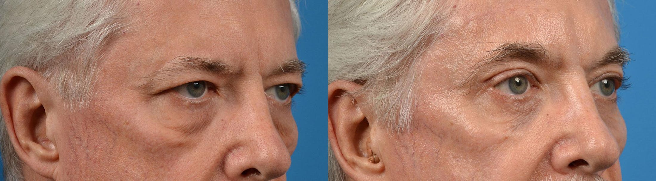 Eyelid Surgery Before & After Gallery - Patient 122444638 - Image 2