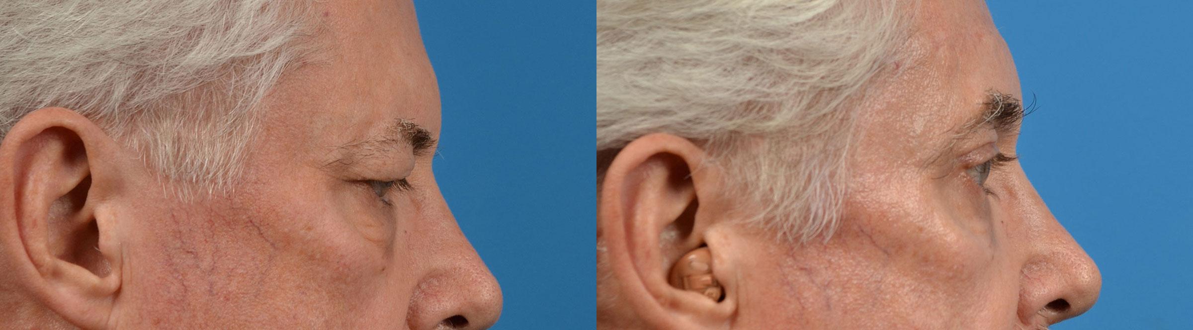 Eyelid Surgery Before & After Gallery - Patient 272484 - Image 3