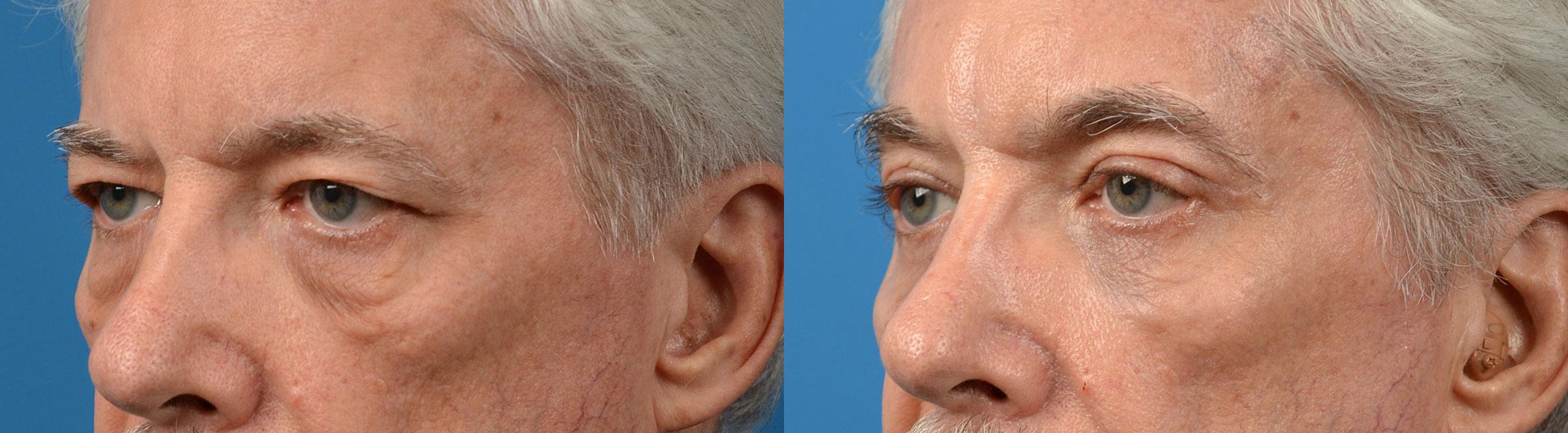 Eyelid Surgery Before & After Gallery - Patient 272484 - Image 4