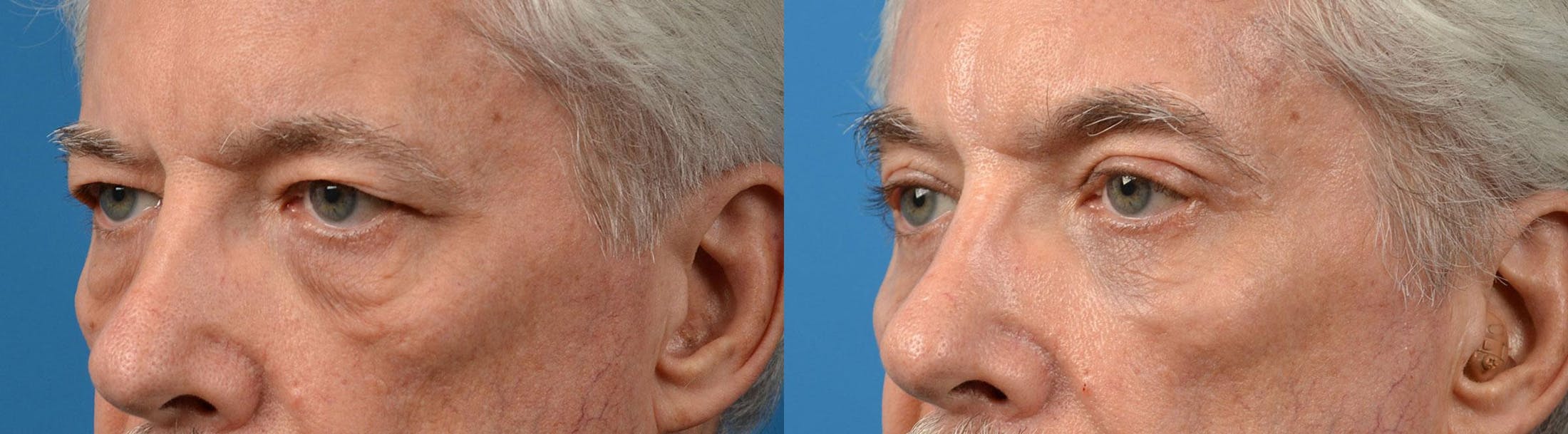 Eyelid Surgery Before & After Gallery - Patient 122444638 - Image 4
