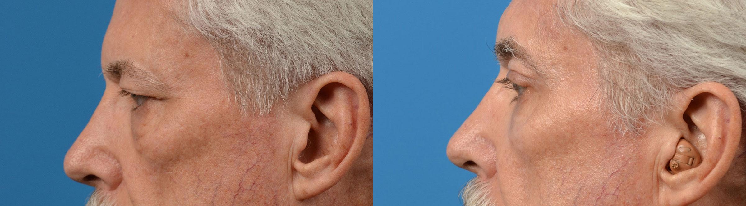 Eyelid Surgery Before & After Gallery - Patient 272484 - Image 5