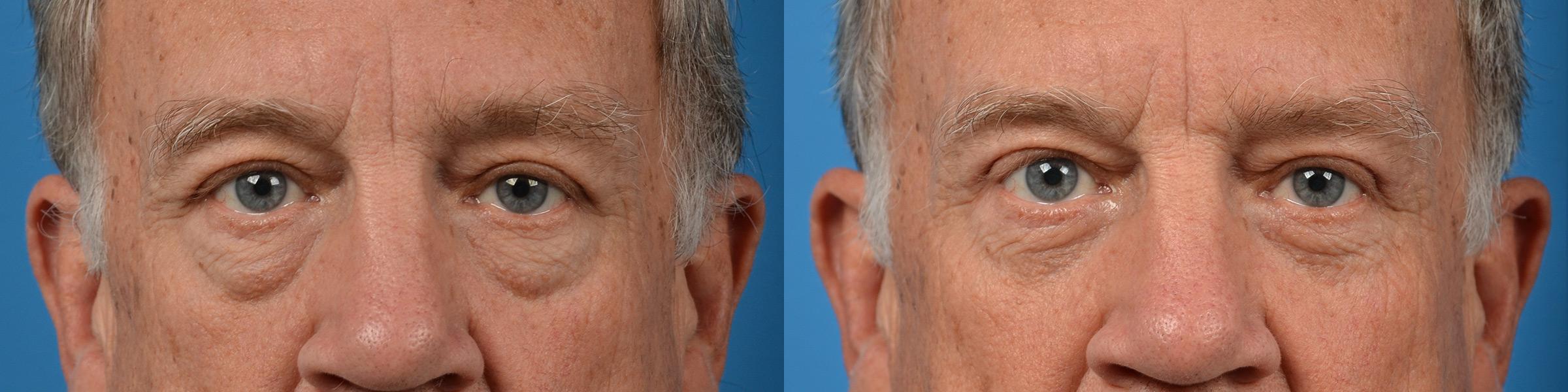 Eyelid Surgery Before & After Gallery - Patient 194719 - Image 1