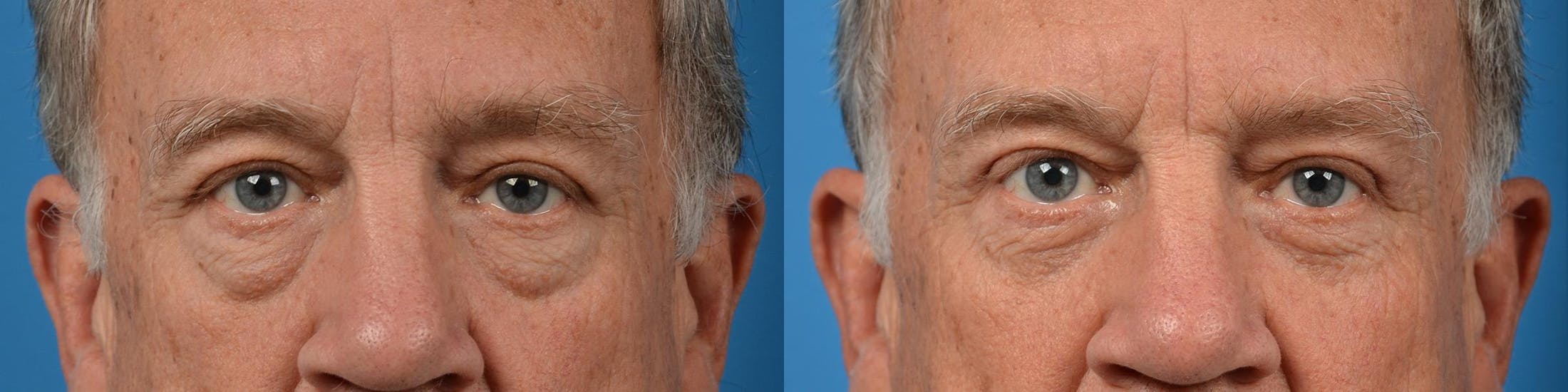 Eyelid Surgery Before & After Gallery - Patient 122444644 - Image 1
