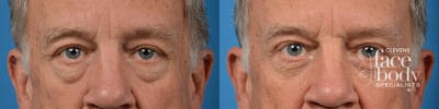 Eyelid Surgery Before & After Gallery - Patient 194719 - Image 1