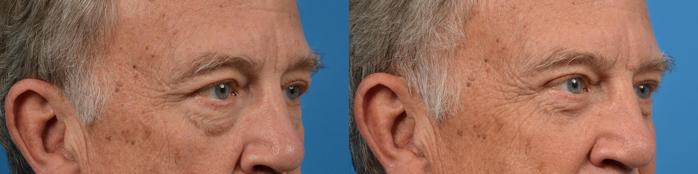 Eyelid Surgery Before & After Gallery - Patient 194719 - Image 2