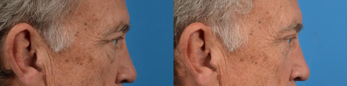 Eyelid Surgery Before & After Gallery - Patient 122444644 - Image 3
