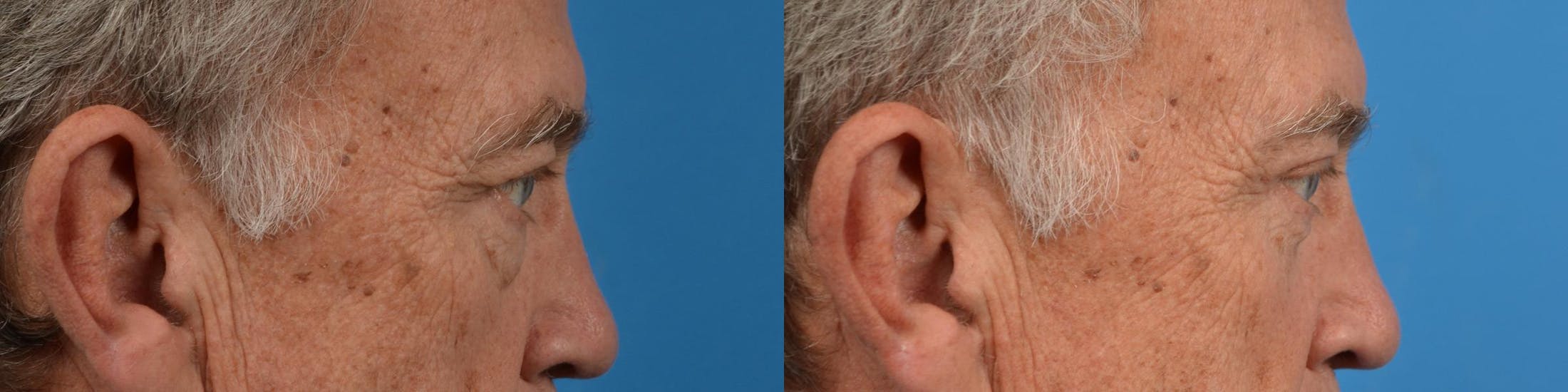 Eyelid Surgery Before & After Gallery - Patient 122444644 - Image 3