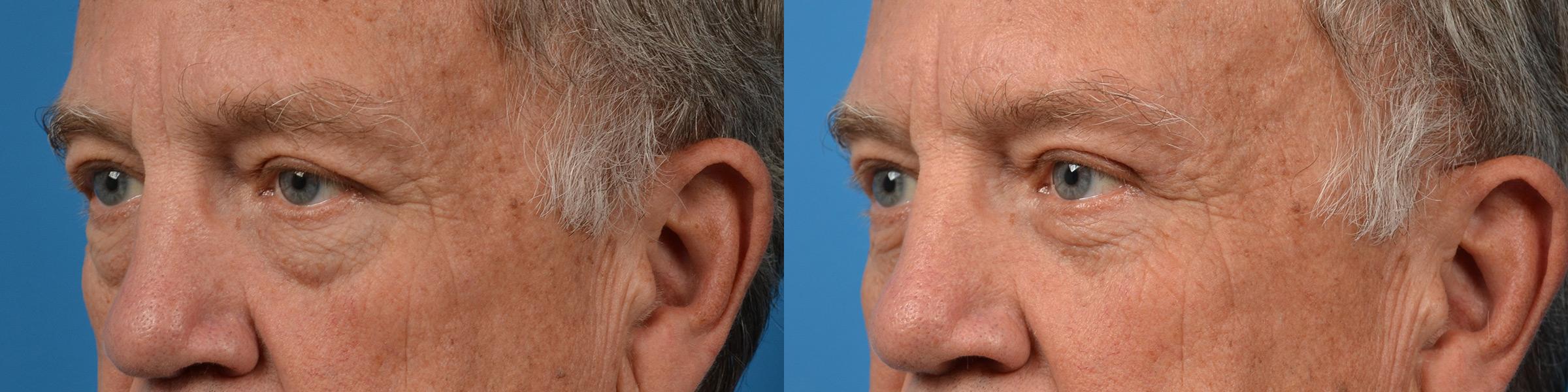 Eyelid Surgery Before & After Gallery - Patient 194719 - Image 4