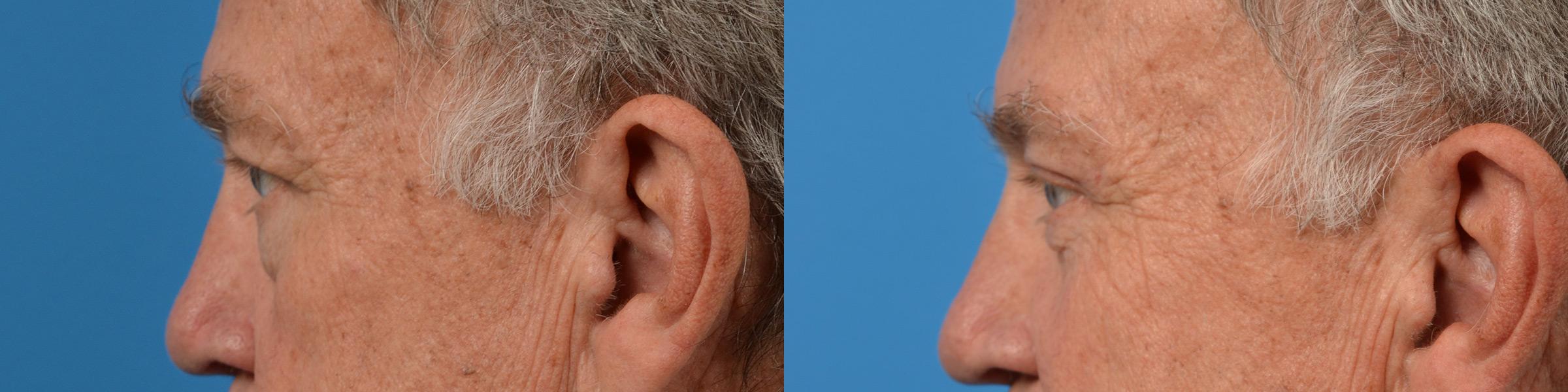 Eyelid Surgery Before & After Gallery - Patient 194719 - Image 5