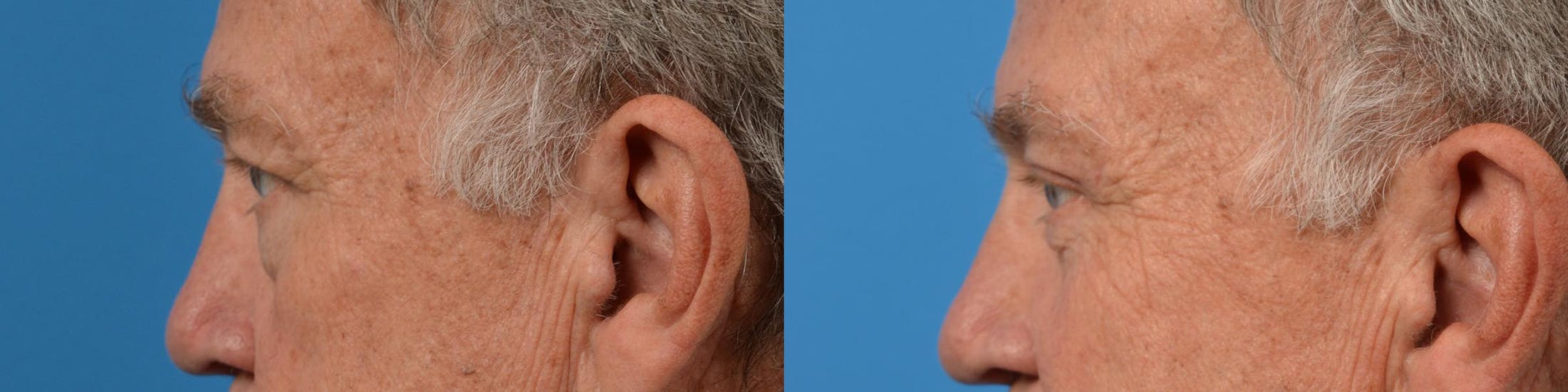Eyelid Surgery Before & After Gallery - Patient 122444644 - Image 5