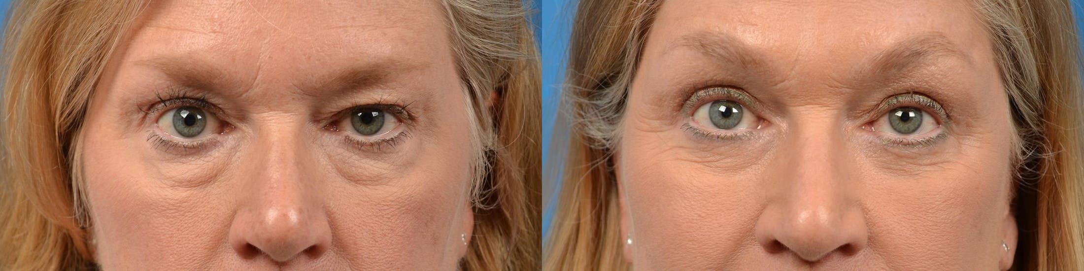 Eyelid Surgery Before & After Gallery - Patient 122444648 - Image 1