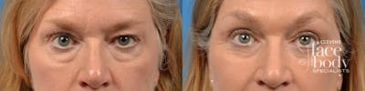 Eyelid Surgery Before & After Gallery - Patient 143551 - Image 1