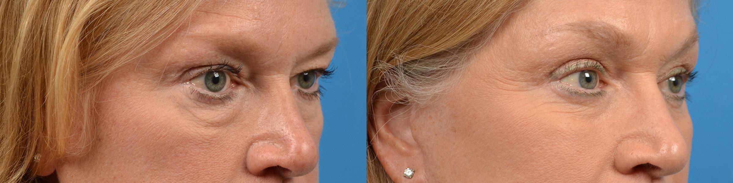 Eyelid Surgery Before & After Gallery - Patient 143551 - Image 2