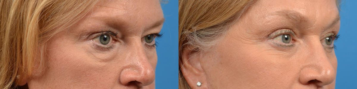 Eyelid Surgery Before & After Gallery - Patient 122444648 - Image 2