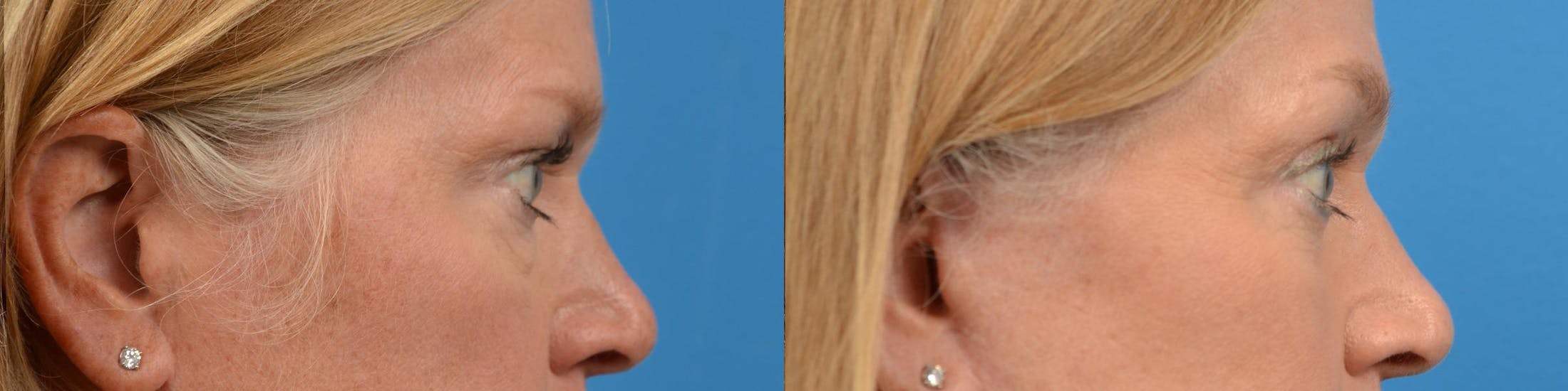 Eyelid Surgery Before & After Gallery - Patient 122444648 - Image 3