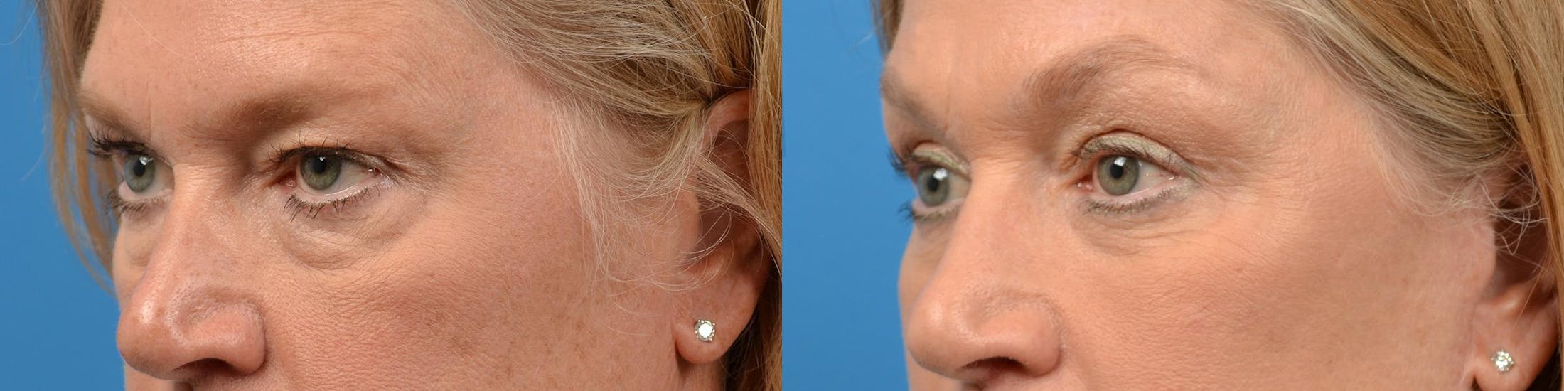 Eyelid Surgery Before & After Gallery - Patient 122444648 - Image 4