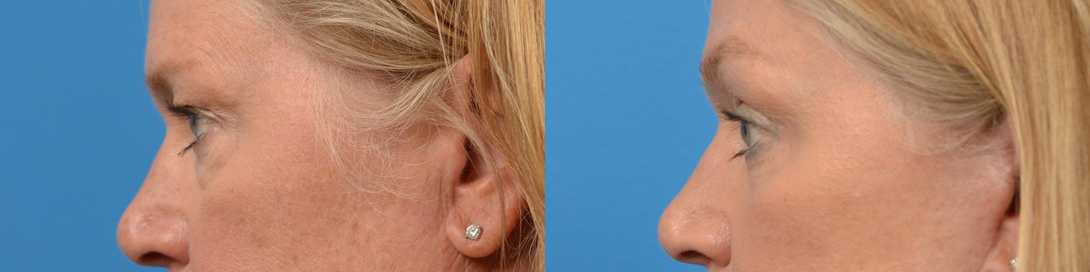 Eyelid Surgery Before & After Gallery - Patient 122444648 - Image 5