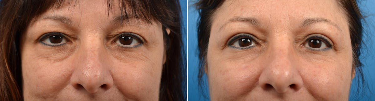 Eyelid Surgery Before & After Gallery - Patient 122444659 - Image 1