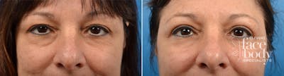 Eyelid Surgery Before & After Gallery - Patient 307332 - Image 1
