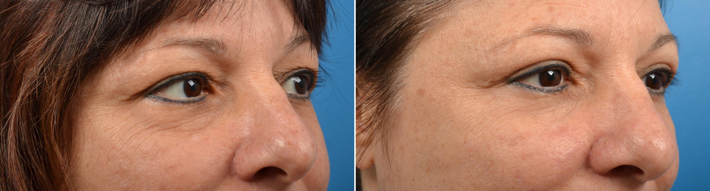 Eyelid Surgery Before & After Gallery - Patient 307332 - Image 2