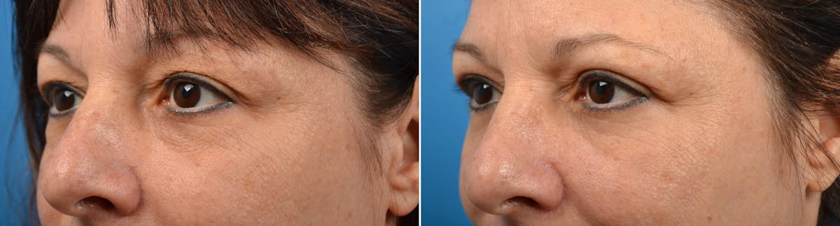 Eyelid Surgery Before & After Gallery - Patient 122444659 - Image 3