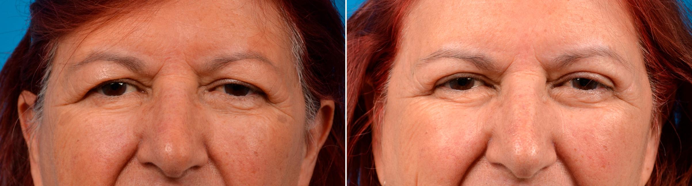 Eyelid Surgery Before & After Gallery - Patient 175083 - Image 1