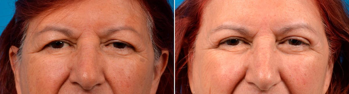 Eyelid Surgery Before & After Gallery - Patient 122444662 - Image 1