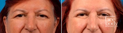 Eyelid Surgery Before & After Gallery - Patient 175083 - Image 1