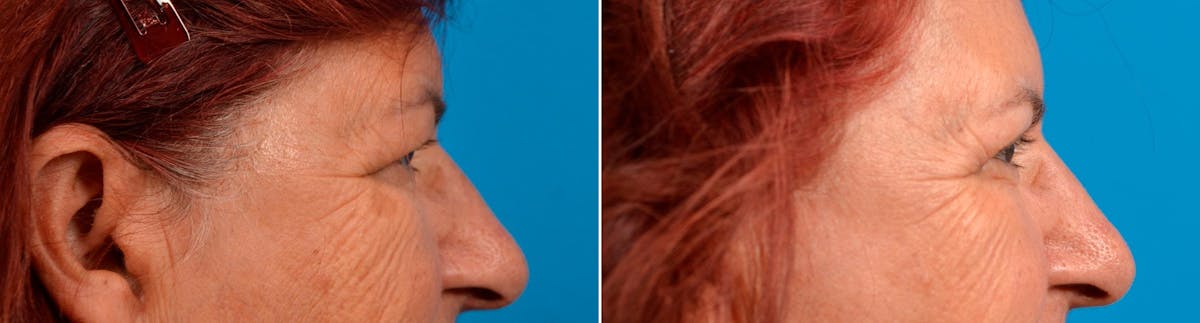 Eyelid Surgery Before & After Gallery - Patient 122444662 - Image 2