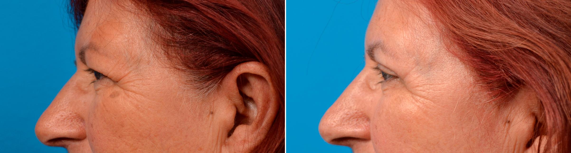 Eyelid Surgery Before & After Gallery - Patient 175083 - Image 3