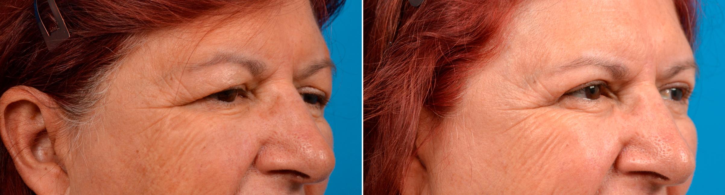 Eyelid Surgery Before & After Gallery - Patient 175083 - Image 4