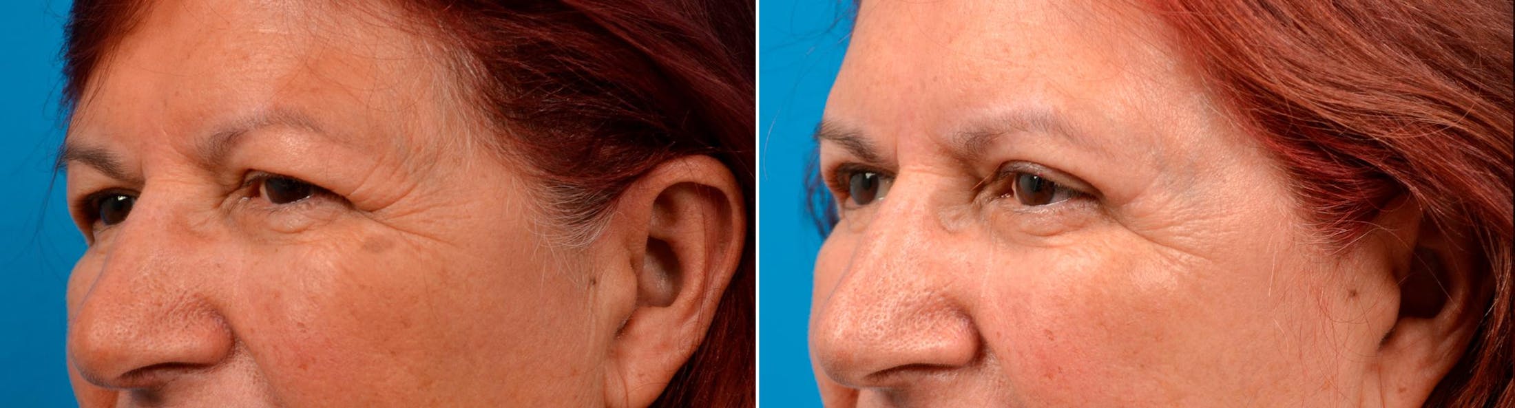 Eyelid Surgery Before & After Gallery - Patient 122444662 - Image 5