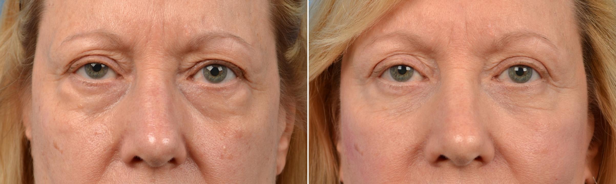 Eyelid Surgery Before & After Gallery - Patient 471487 - Image 1