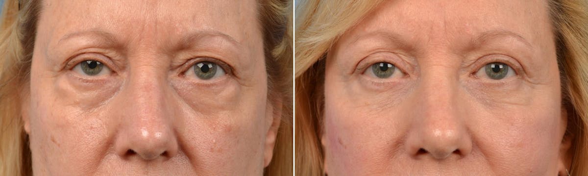 Eyelid Surgery Before & After Gallery - Patient 122444669 - Image 1