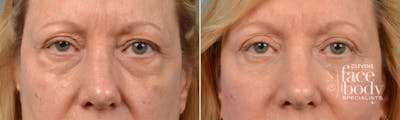 Eyelid Surgery Before & After Gallery - Patient 471487 - Image 1