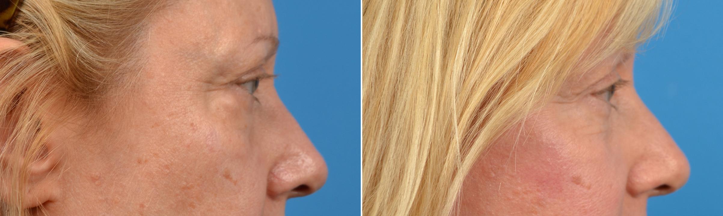Eyelid Surgery Before & After Gallery - Patient 471487 - Image 2