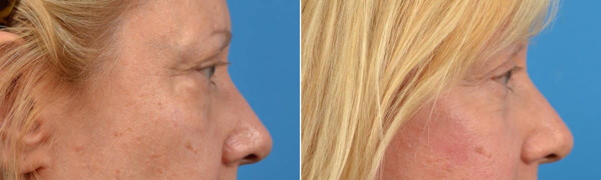 Eyelid Surgery Before & After Gallery - Patient 122444669 - Image 2
