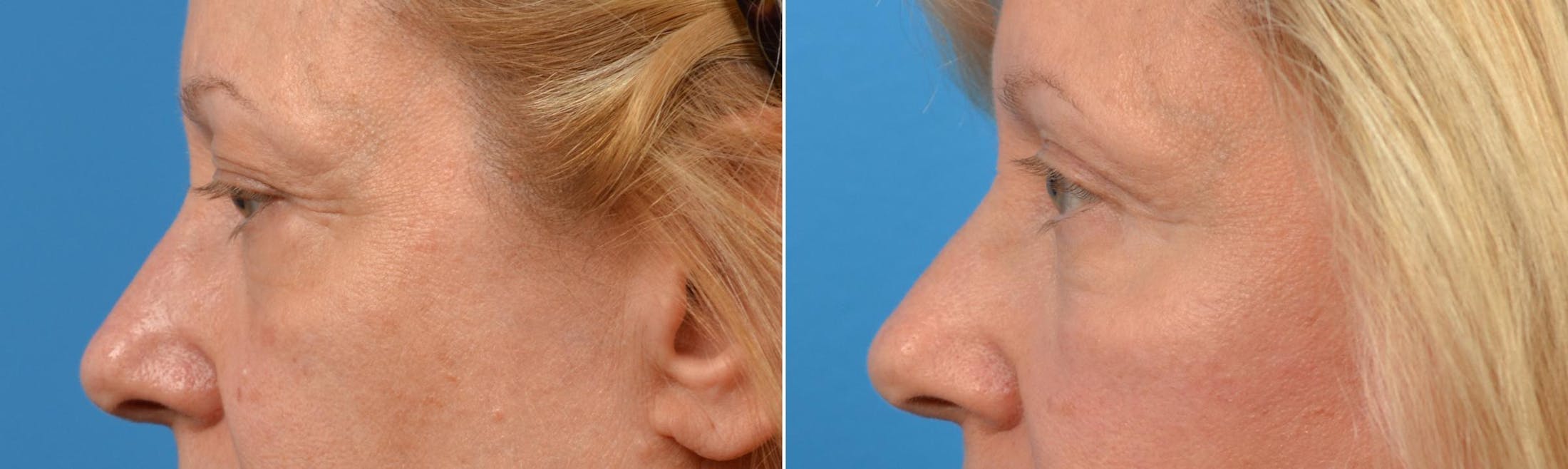 Eyelid Surgery Before & After Gallery - Patient 122444669 - Image 3
