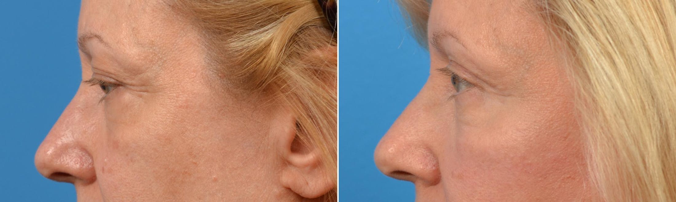Eyelid Surgery Before & After Gallery - Patient 122444669 - Image 3