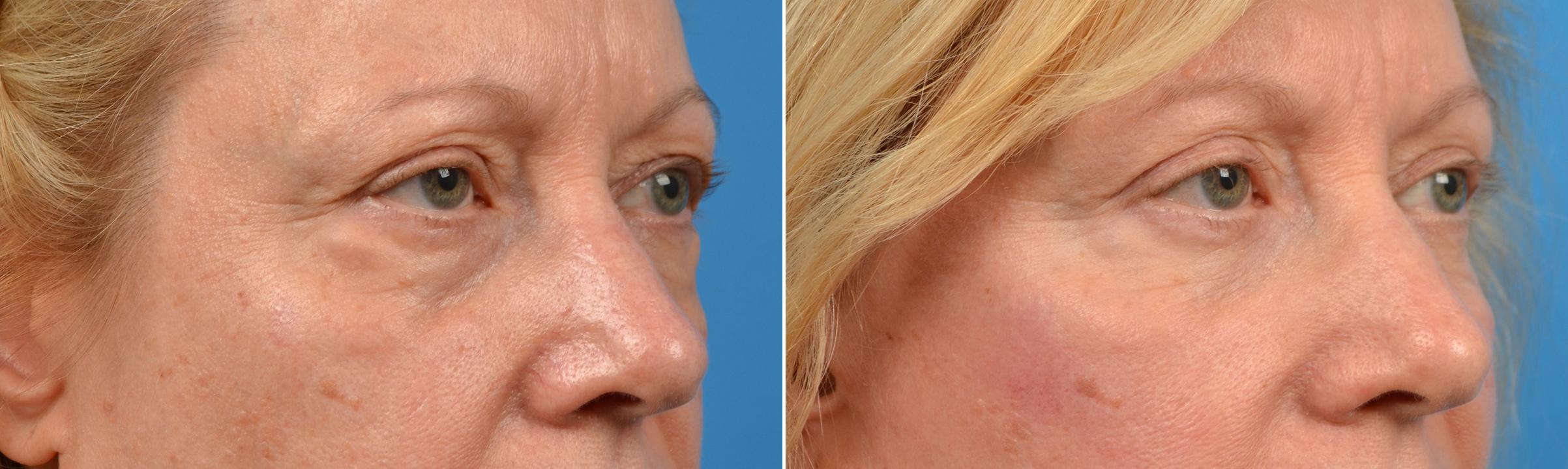 Eyelid Surgery Before & After Gallery - Patient 471487 - Image 4