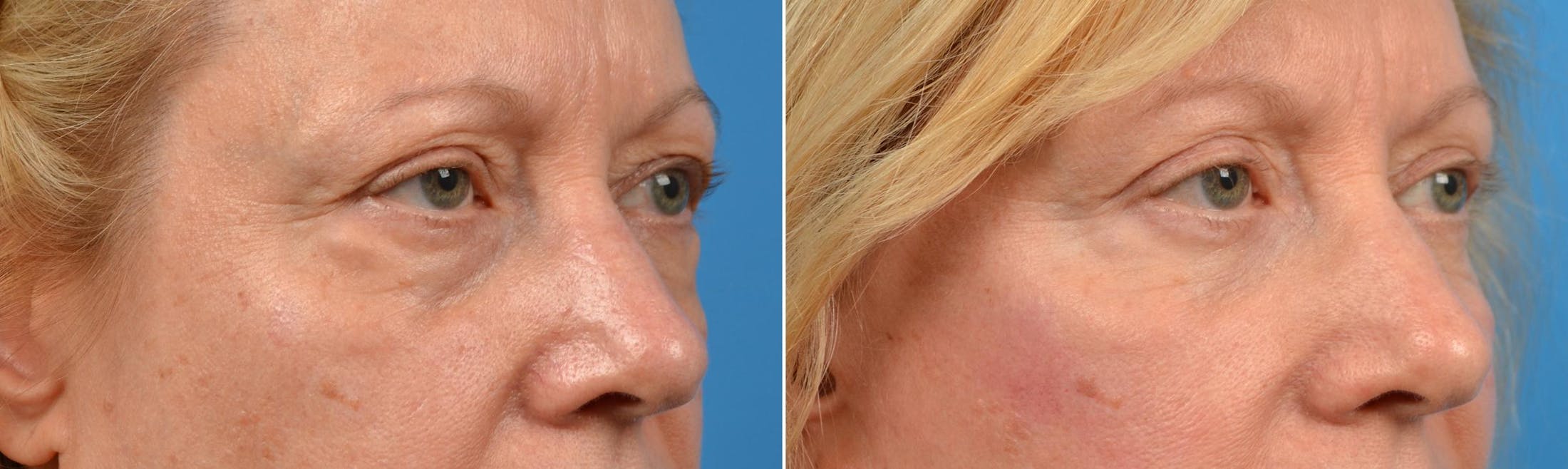 Eyelid Surgery Before & After Gallery - Patient 122444669 - Image 4