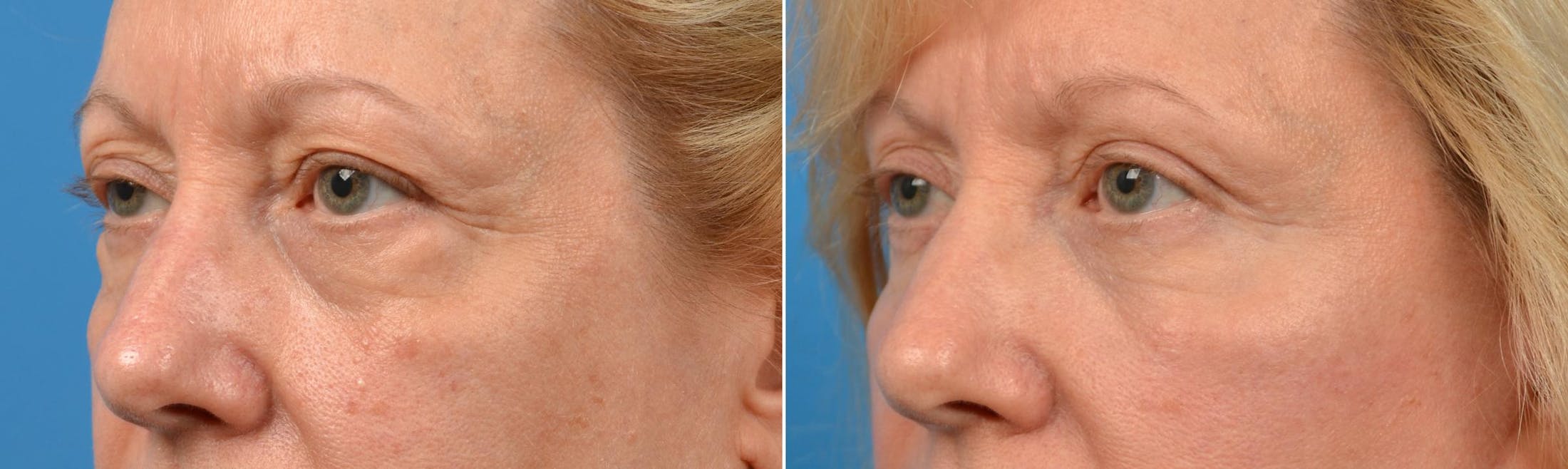 Eyelid Surgery Before & After Gallery - Patient 122444669 - Image 5